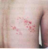 herpes-zoster6day.jpg