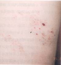 herpes-zoster10day.jpg