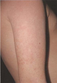 erythema02.jpg