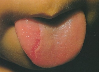 geographic_tongue01.jpg