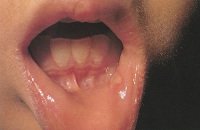 aphthous_stomatitis01.jpg