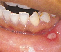 aphthous_stomatitis02.jpg