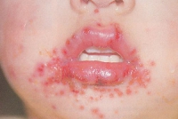 herpes_S_V02.jpg