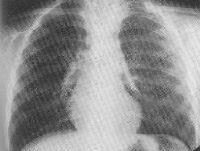 pneumomediarinum.jpg