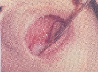 herpangina.jpg