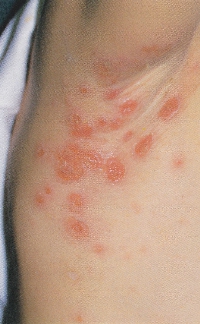 impetigo_contagiosa.jpg