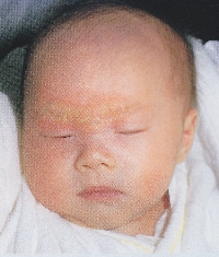 infantile_seborrheic_dermatitis01.jpg