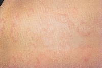 infantile_seborrheic_dermatitis02.jpg