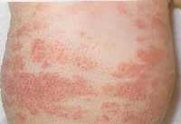 atopic_dermatitis01.jpg