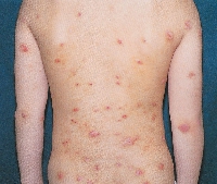 atopic_dermatitis06.jpg