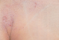 atopic_dermatitis07.jpg