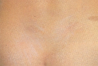 atopic_dermatitis08.jpg