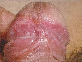 balanoposthitis01.jpg