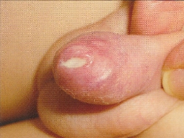 balanoposthitis02.jpg