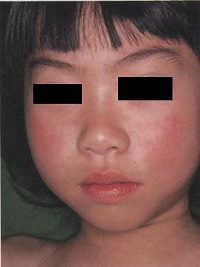 measles01.jpg