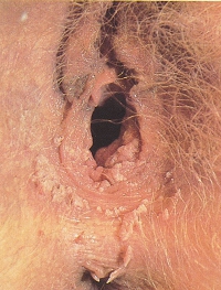 hpv01.jpg