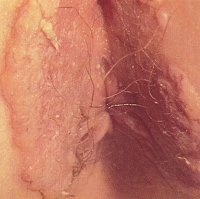 hpv02.jpg