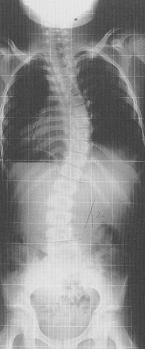 scoliosis_03.jpg