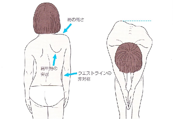 scoliosis_01.jpg