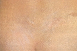 atopic_dermatitis08.jpg