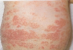 atopic_dermatitis01.jpg