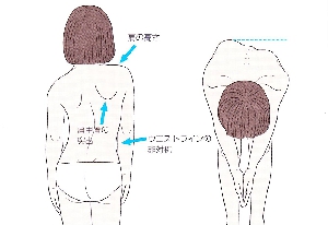 scoliosis_01.jpg