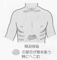 epiglottitis-02.jpg