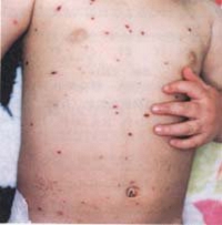 varicella6day.jpg