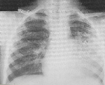 pneumoniae.jpg