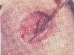 herpangina.jpg