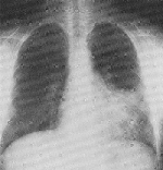 mycoplasma_pneumoniae.jpg