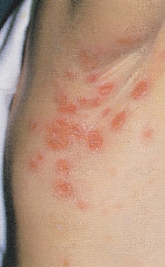 impetigo_contagiosa.jpg