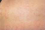 infantile_seborrheic_dermatitis02.jpg