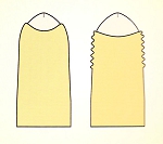 phimosis02.jpg