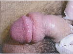 phimosis03.jpg